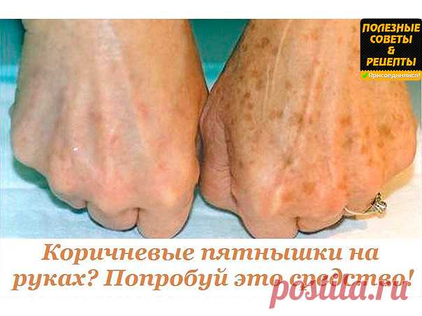 Пигментные пятнышки на коже
