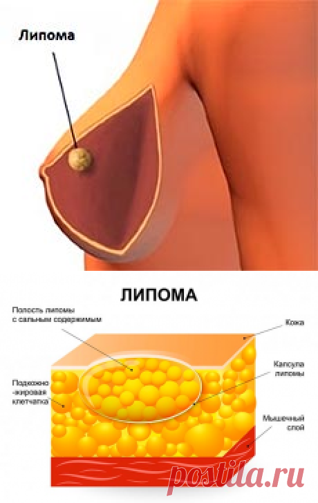Липома молочной железы: что это такое и как лечится?