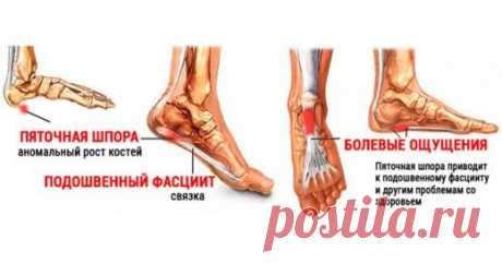 8 народных рецептов лечения пяточной шпоры | Golbis