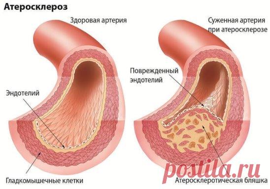 Атеросклероз сосудов ног: тревожные симптомы
Атеросклероз сосудов ног — хроническое заболевание, самым распространенным симптомом которого  являются болезненные мышечные судороги в бедрах или икрах ног при ходьбе, подъеме по лестнице или во время физической тренировки.Боль часто уходит, когда вы прекращаете тренировку, хотя и не сразу ? на это может понадобиться несколько минут. Работающим мышцам нужно больше крови, несущей кислород, чем отдыхающим, но на переход от работы к отдыху требуется не