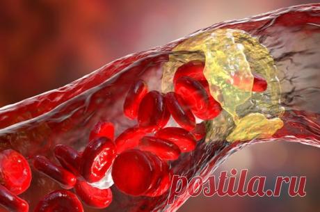 Чем опасны скрытые бляшки в сосудах / Будьте здоровы