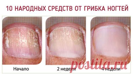 Самые эффективные народные средства от грибка ногтей - Мир красоты