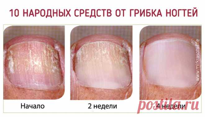 Самые эффективные народные средства от грибка ногтей - Мир красоты