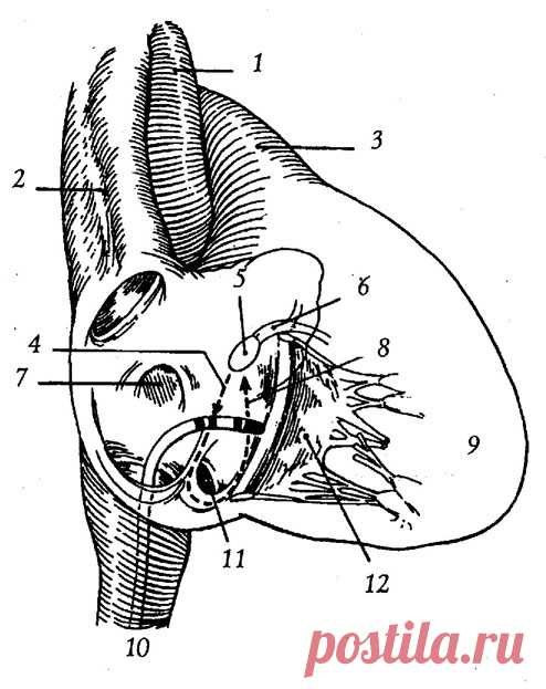 Катетерная аблация (деструкция), Лечение нарушений ритма и проводимости, CardioSchool