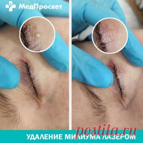 Как удалить милиум (жировик, "просянка", белый угорь):

#Милиум - эпидермальная киста сальной железы (волосяной фолликулы), образующаяся при закупорке выводного протока, заполненная кожным салом и кератином. Чаще всего новообразования появляются в периорбитальной зоне (зоне глаз), на скулах, веках и зоне лба. Размер образования составляет до 3 мм.
Показать полностью...