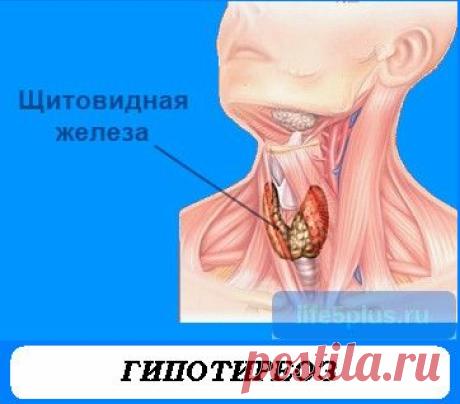 Гипотиреоз щитовидной железы |