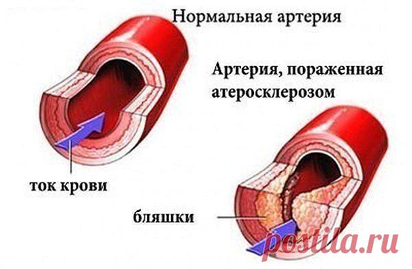 Укроп, мед и валериана - и сосуды без изъяна!