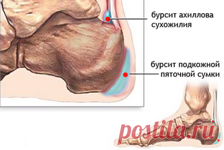Пяточный бурсит причины симптомы лечение | Восстановление здоровья и медицина