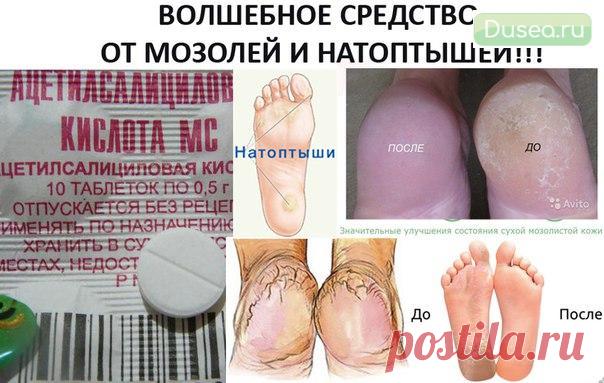 Жесткие мозоли на пятках, их еще называют «натоптыши” легко устраняются с помощью аспирина | Dusea.ru | Первый женский