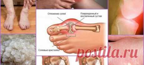 Заболевания суставов, которые в России пытаются &quot;лечить&quot; по отдельности, в Европе уже давно объединены в одно заболевание «Articulatio de sales» (Солевые образования суставов). Это заболевание включает в себя:
Подагру
Артрит
Артроз
Остеохондроз
Ревматизм
Остеопороз
Бурсит
Синовит
Гигрому
Это очень краткий список, но остальные заболевания являются лишь подвидом этих основных девяти патологий. Например, коксартроз это подвид артроза и т.п.