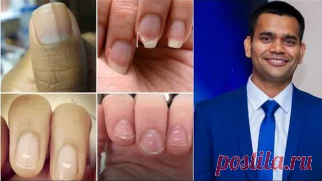 Что Ногти Расскажут О Вашем Здоровье | Диагноз По Ногтям | Доктор Вивек