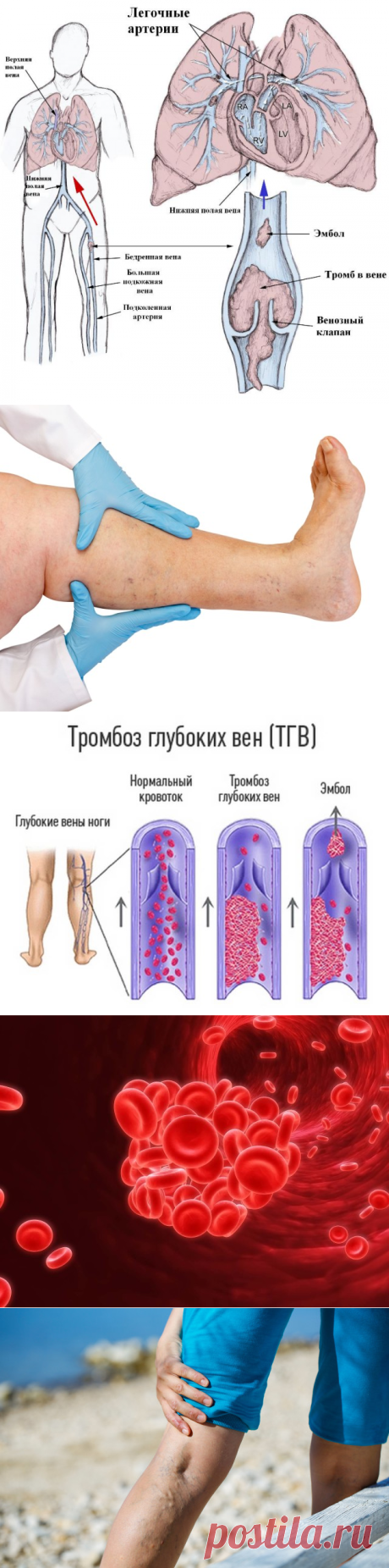 Тромбофлебит — МКБ-10: тромбоз глубоких вен нижних конечностей