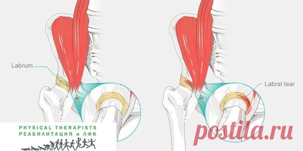 ЩЕЛКАЕТ БЕДРО?

Синдром щелкающего бедра, как логично следует из названия - это щелчки в бедре или в тазобедренном суставе, возникающие при движениях, часто сопровождающиеся болью. Иногда при щелчках бывает не только боль, но и чувство пружинящего сопротивления движению, сменяющимся чувством провала в пустоту. В медицине щелкающее бедро называют еще латинским термином coxa saltans.
Показать полностью…