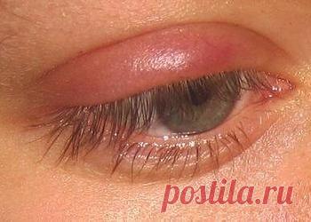 Лечения ячменя на глазу народными средствами