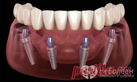 Имплантация зубов All-on-4: преимущества и недостатки методики моментального протезирования
Протокол имплантации под названием «All-on-4» («Все на четырех») предполагает протезирование зубов несъемным протезом, опорой для которого выступают четыре импланта. Показания для такого вида имплантации могут быть следующими: полная адентия челюсти; большое количество зубов, не подлежащих восстановлению,...
Читай пост далее на сайте. Жми ⏫ссылку выше