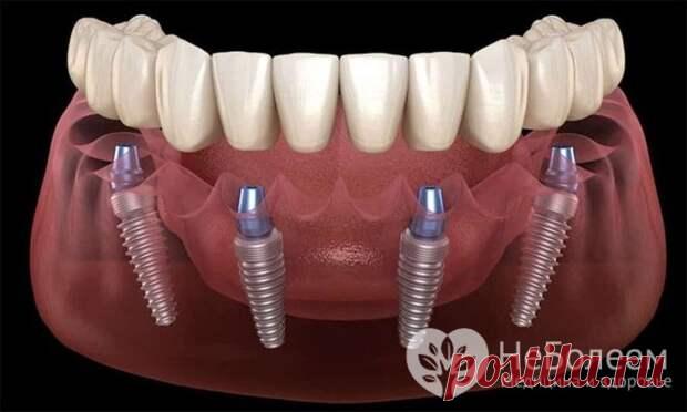 Имплантация зубов All-on-4: преимущества и недостатки методики моментального протезирования
Протокол имплантации под названием «All-on-4» («Все на четырех») предполагает протезирование зубов несъемным протезом, опорой для которого выступают четыре импланта. Показания для такого вида имплантации могут быть следующими: полная адентия челюсти; большое количество зубов, не подлежащих восстановлению,...
Читай пост далее на сайте. Жми ⏫ссылку выше