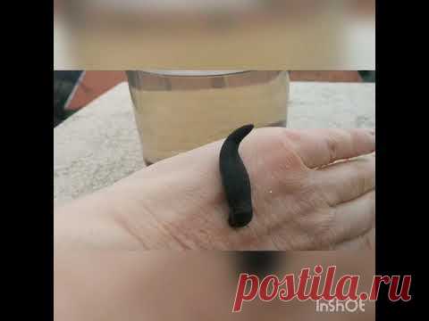 Пиявки. 5 грубых ошибок при постановке пиявок