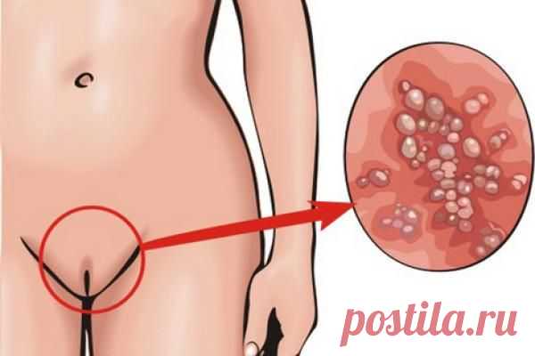 СИФИЛИС - СИМПТОМЫ И ЛЕЧЕНИЕ