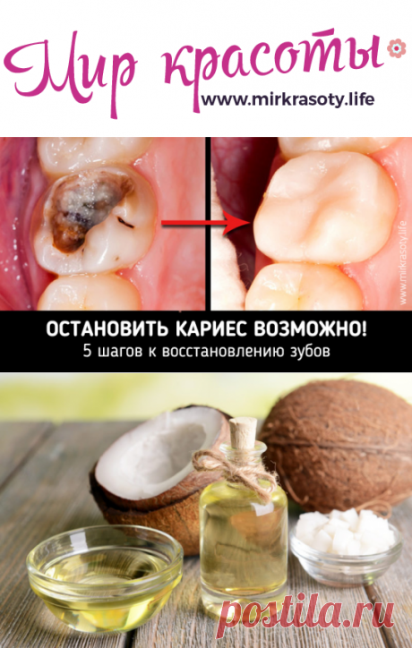 Остановить кариес возможно! 5 шагов к восстановлению зубов - Мир красоты