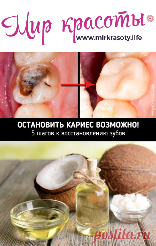 Остановить кариес возможно! 5 шагов к восстановлению зубов - Мир красоты