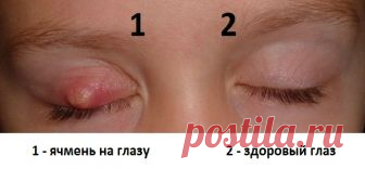 КАК ЛЕЧИТЬ ЯЧМЕНЬ НА ГЛАЗУ ?