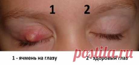 КАК ЛЕЧИТЬ ЯЧМЕНЬ НА ГЛАЗУ ?
