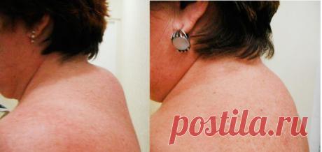 Как легко избавиться от холки на спине? Вдовий горбик, загривок, холка, жировик – вот народные названия этой проблемы.