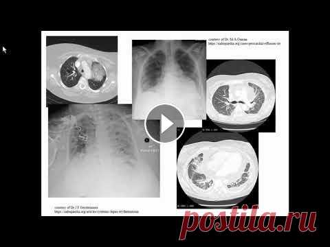 Боярская Ю.B. «Пневмоцистная пневмония vs люпус-пневмонит (как дебют СКВ) у пациента без ВИЧ» Боярская Ю.B. «Пневмоцистная пневмония vs люпус-пневмонит (как дебют СКВ) у пациента без ВИЧ»...