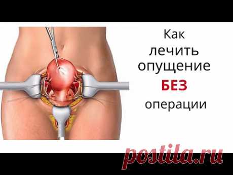 Как лечить опущение БЕЗ операции. Упражнения при опущении матки, влагалища, недержании мочи