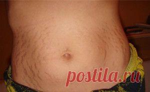 Способы избавиться от растяжек навсегда