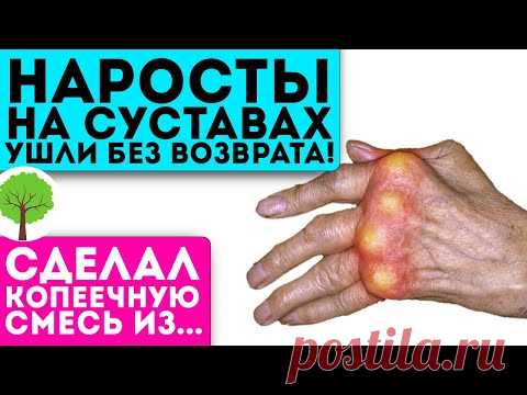 Врач был в шоке, когда увидел мои руки! За 10 процедур суставы стали как новенькие!