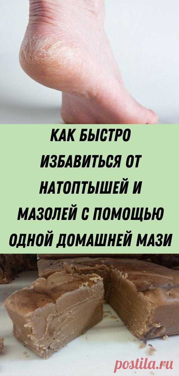 Как быстро избавиться от натоптышей и мазолей с помощью одной домашней мази