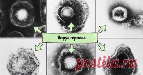 Вирус герпеса