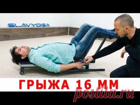 Межпозвоночная грыжа поясничного отдела 16 мм со стенозом позвоночного канала: тренажёр MAST