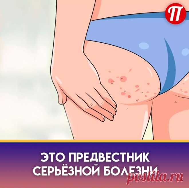 1. Прыщи в области нижней челюсти и шеи могут указывать на повышенный уровень сахара в крови, чрезмерную активность надпочечников.



2. Прыщи в области ягодиц могут быть разного цвета, формы и размера. Выделяется несколько разновидностей таких образований:

Кисты – небольшие образования, которые выглядят как припухлости кожных покровов. Такое образование затрагивает глубокие слои эпидермиса. Внутри кисты – серозное содержимое.
Фурункул – это достаточно большой прыщ на попе.