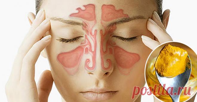 Куркума и соленая вода - эффективный способ быстрого облегчения инфекций синуса за несколько минут! Полезно знать! Инфекция синуса — общая проблема со здоровьем, которую большинство из нас пытается решить, принимая фармацевтические лекарства, такие как