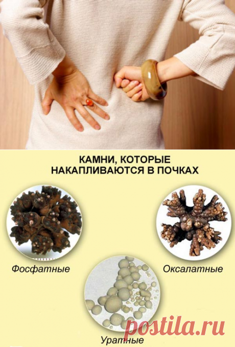Камни в почках (мочекаменная болезнь): симптомы и причины