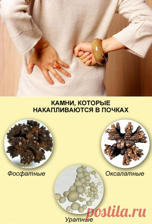 Камни в почках (мочекаменная болезнь): симптомы и причины