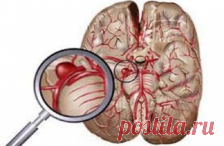 Чистим сосуды головного мозга