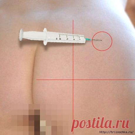 Внутримышечная инъекция - делаем укол сами