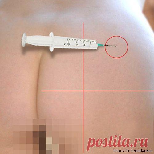 Внутримышечная инъекция - делаем укол сами