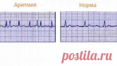 Пять простых способов успокоить сердце при аритмии Обычно человек не ощущает биение своего сердца. Но часто при физических нагрузках, в стрессовых ситуациях сердце начинает учащенно биться, нарушая привычный ритм. Может появиться резкая слабость, учас…