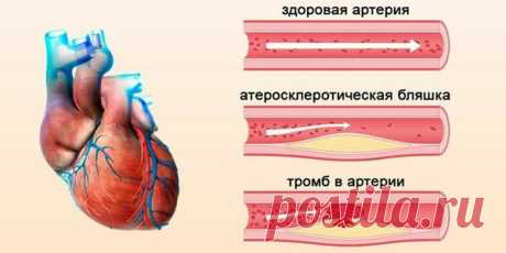 5 продуктов, которые на самом деле чистят сосуды Атеросклероз или так называемый рост бляшек в сосудах приводит нарушению правильного кровотока и кровоснабжению жизненно важных органов. Вместе с тем бляшки часто становятся нестабильными, повреждаютс…