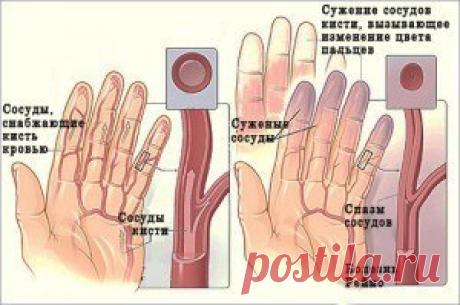 НАРОДНЫЕ СРЕДСТВА ПРОТИВ ОНЕМЕНИЯ РУК И НОГ.