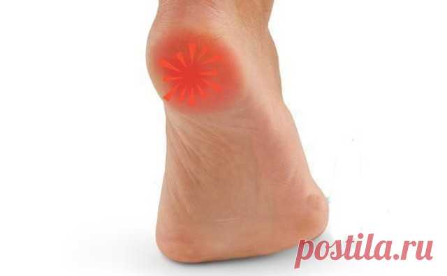 Пяточная шпора - что такое и как лечить 
Пяточная шпора или плантарный фасциит – болезненное образование в месте прикрепления связок к стопе. Шиповидное разрастание костей доставляет человеку мучительную боль при нагрузке на ноги. Возникают натоптыши, кожные наросты.
Пяточная шпора – опасный симптом, сопровождающийся воспалительным процессом. Остеофит возникает по нескольким причинам. При первых признаках изменения пяточной кости требуется курс профилактического лечения.