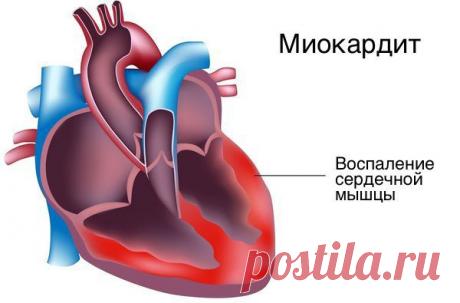 Желудочковая экстрасистолия: причины, симптомы и лечение в статье аритмолога Колесниченко И. В.