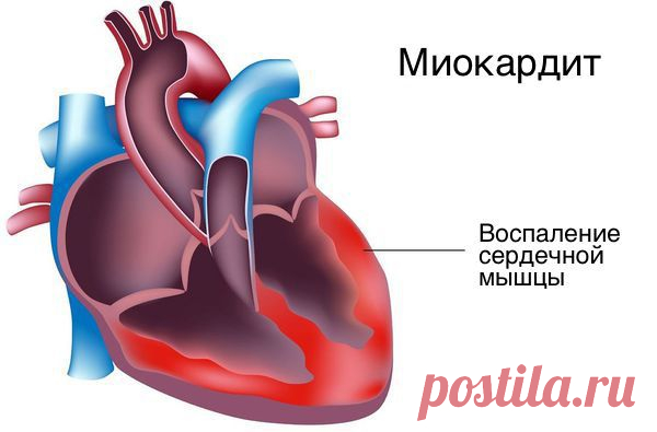 Желудочковая экстрасистолия: причины, симптомы и лечение в статье аритмолога Колесниченко И. В.