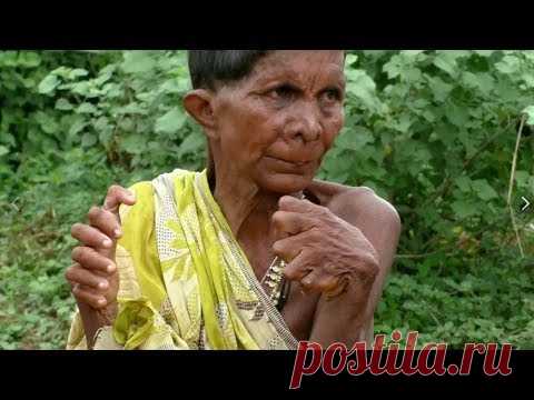 ЖЕНЩИНА, у которой 31 ПАЛЕЦ на руках и ногах - YouTube