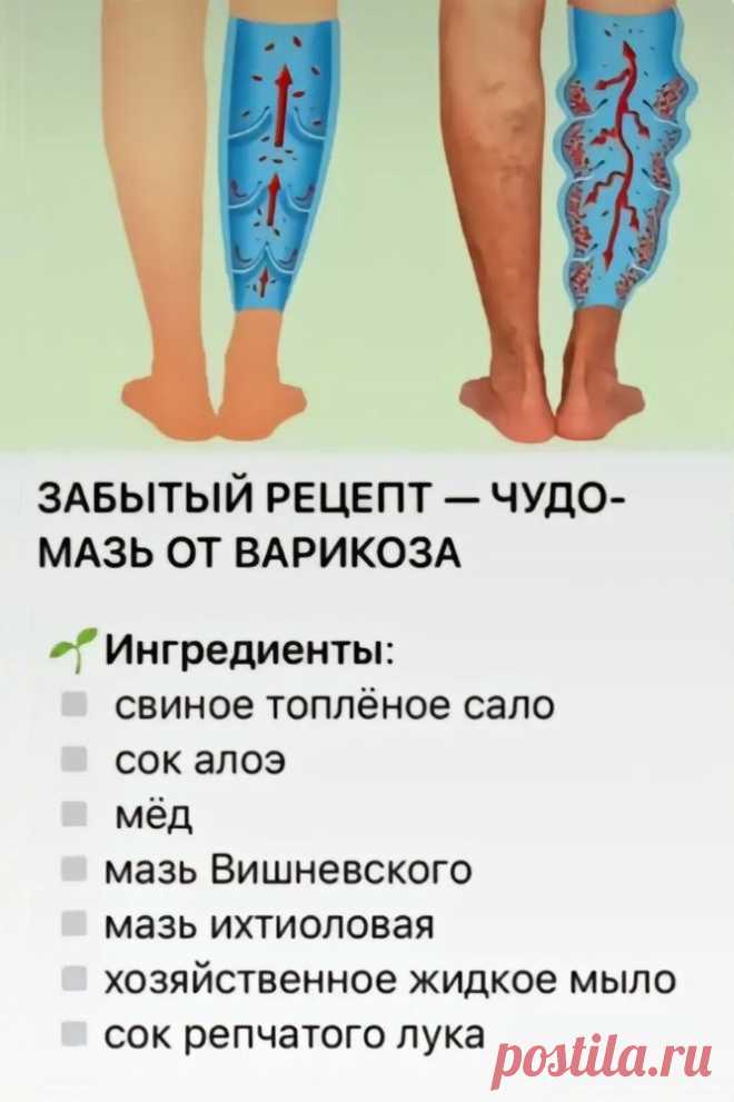 Чудо-мазь от варикоза