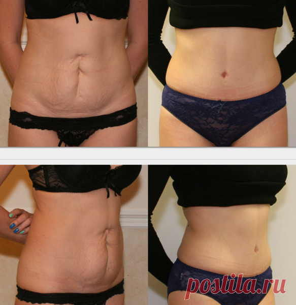 Мой личный опыт борьбы с жиром на животе: справилась аптечным средством за 100 руб.(15 применений) | Худеем Дома | Яндекс Дзен